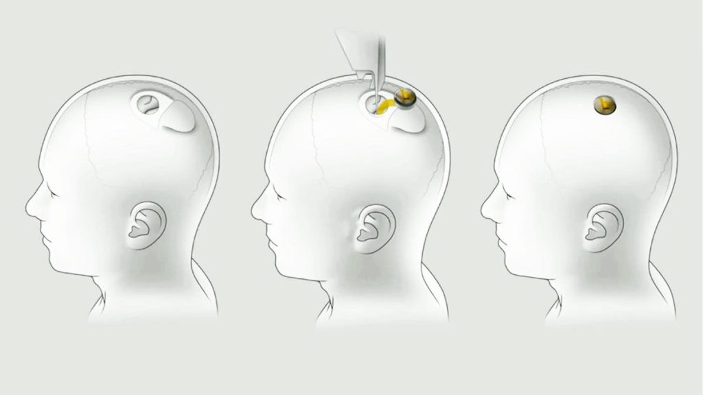 Neuralink installation